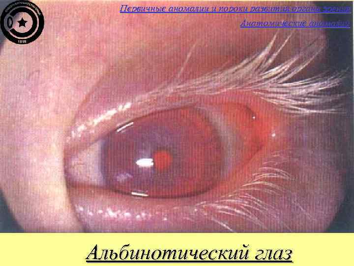 Первичные аномалии и пороки развития органа зрения Анатомические аномалии Альбинотический глаз 