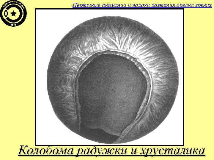 Первичные аномалии и пороки развития органа зрения Колобома радужки и хрусталика 