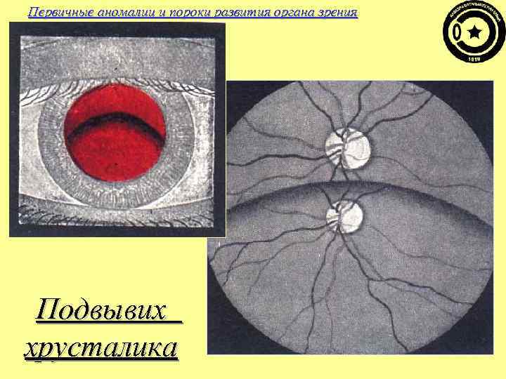 Первичные аномалии и пороки развития органа зрения Подвывих хрусталика 