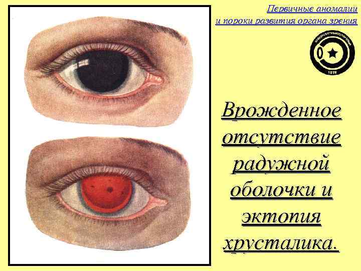 Первичные аномалии и пороки развития органа зрения Врожденное отсутствие радужной оболочки и эктопия хрусталика.