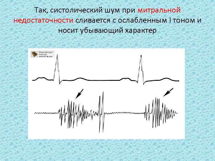 Так, систолический шум при митральной недостаточности сливается с ослабленным I тоном и носит убывающий