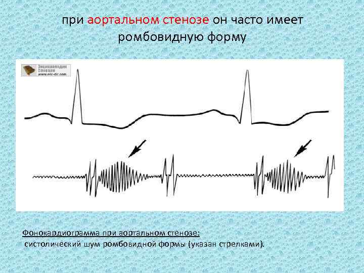 при аортальном стенозе он часто имеет ромбовидную форму Фонокардиограмма при аортальном стенозе: систолический шум