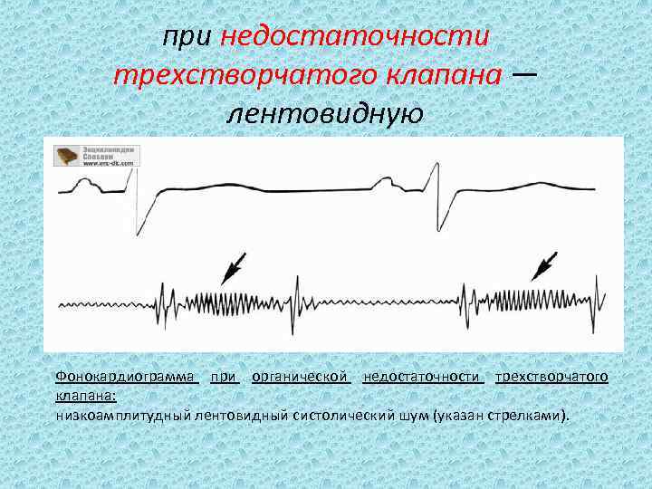 при недостаточности трехстворчатого клапана — лентовидную Фонокардиограмма при органической недостаточности трехстворчатого клапана: низкоамплитудный лентовидный