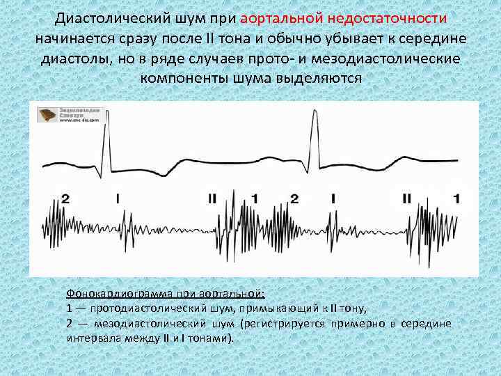 Диастолический шум при аортальной недостаточности начинается сразу после II тона и обычно убывает к