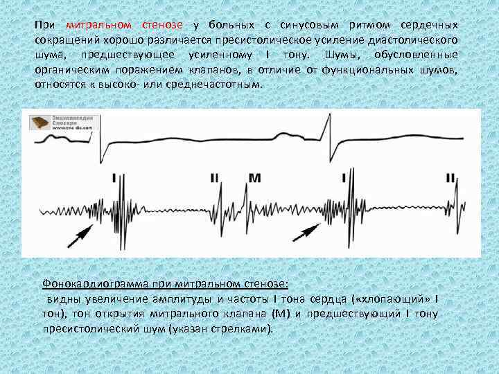 При митральном стенозе у больных с синусовым ритмом сердечных сокращений хорошо различается пресистолическое усиление