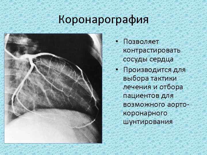 Коронарография • Позволяет контрастировать сосуды сердца • Производится для выбора тактики лечения и отбора