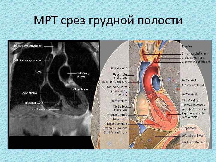 МРТ срез грудной полости 