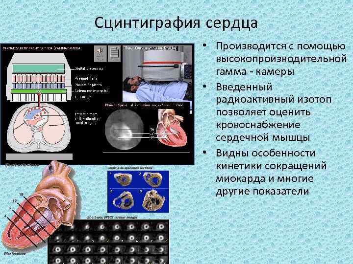 Сцинтиграфия сердца • Производится с помощью высокопроизводительной гамма камеры • Введенный радиоактивный изотоп позволяет