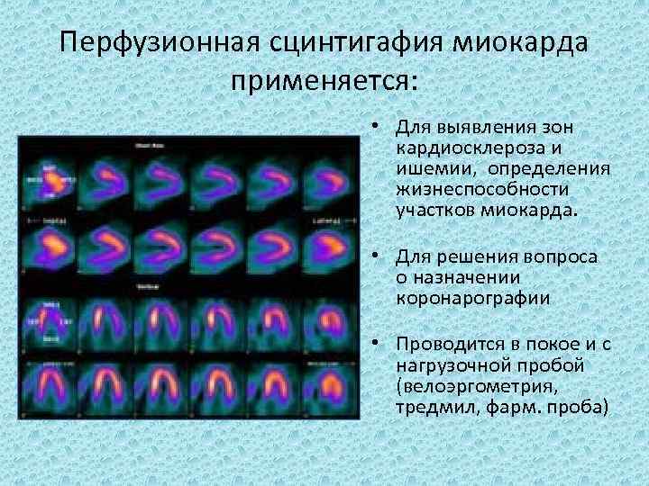 Перфузионная сцинтигафия миокарда применяется: • Для выявления зон кардиосклероза и ишемии, определения жизнеспособности участков