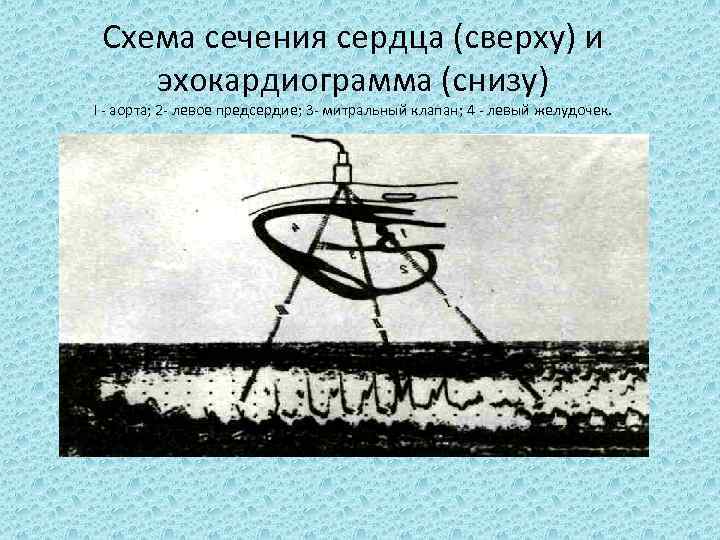 Схема сечения сердца (сверху) и эхокардиограмма (снизу) I аорта; 2 левое предсердие; 3 митральный