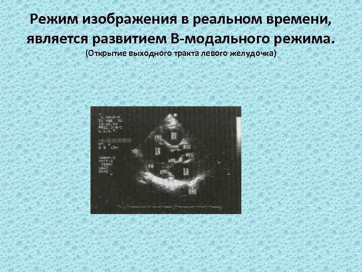 Режим изображения в реальном времени, является развитием В-модального режима. (Открытие выходного тракта левого желудочка)