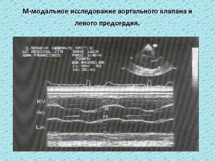 М-модалъное исследование аортального клапана и левого предсердия. 