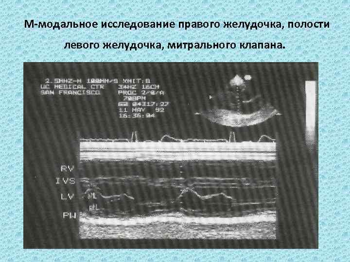 М-модальное исследование правого желудочка, полости левого желудочка, митрального клапана. 