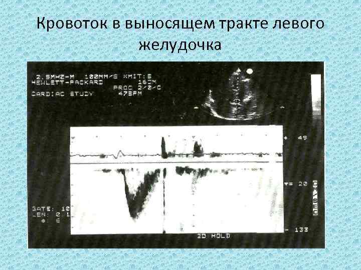 Кровоток в выносящем тракте левого желудочка 