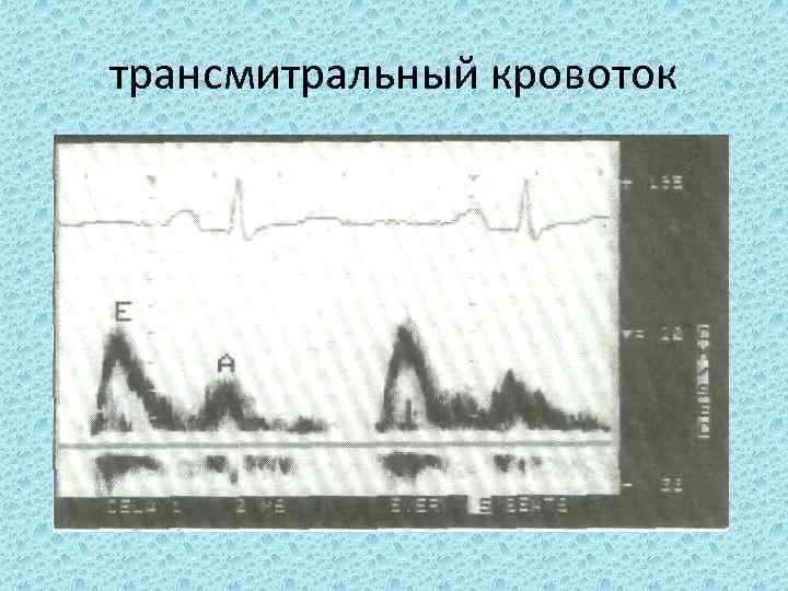 трансмитральный кровоток 