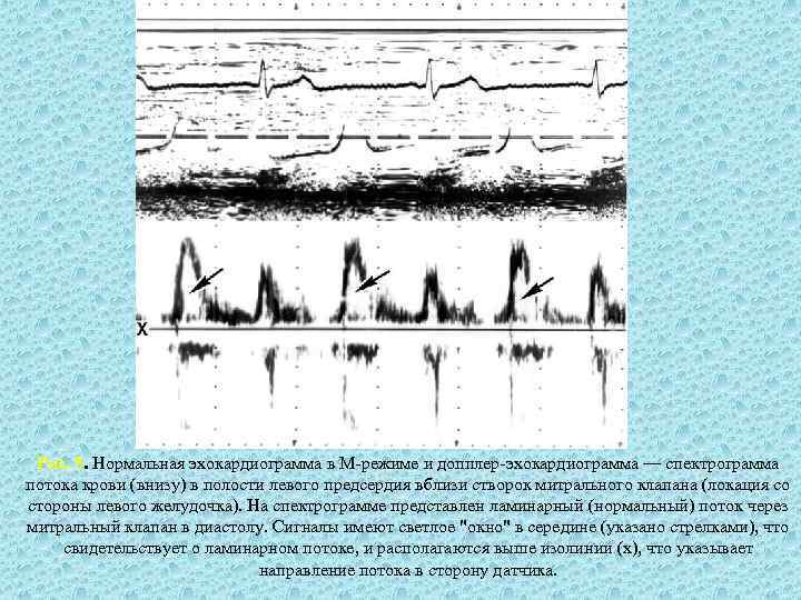 Рис. 5. Нормальная эхокардиограмма в М-режиме и допплер-эхокардиограмма — спектрограмма потока крови (внизу) в