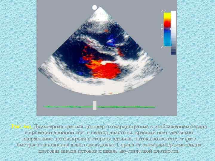 Рис. 6 а). Двухмерная цветная допплер-эхокардиограмма с изображением сердца в проекции длинной оси: в