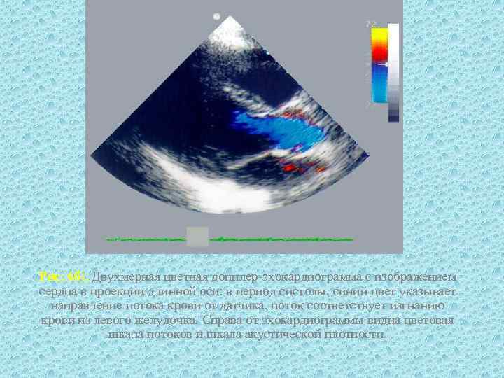 Рис. 6 б). Двухмерная цветная допплер-эхокардиограмма с изображением сердца в проекции длинной оси: в