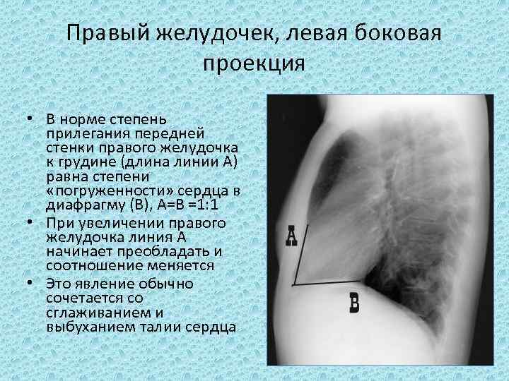 Правый желудочек, левая боковая проекция • В норме степень прилегания передней стенки правого желудочка