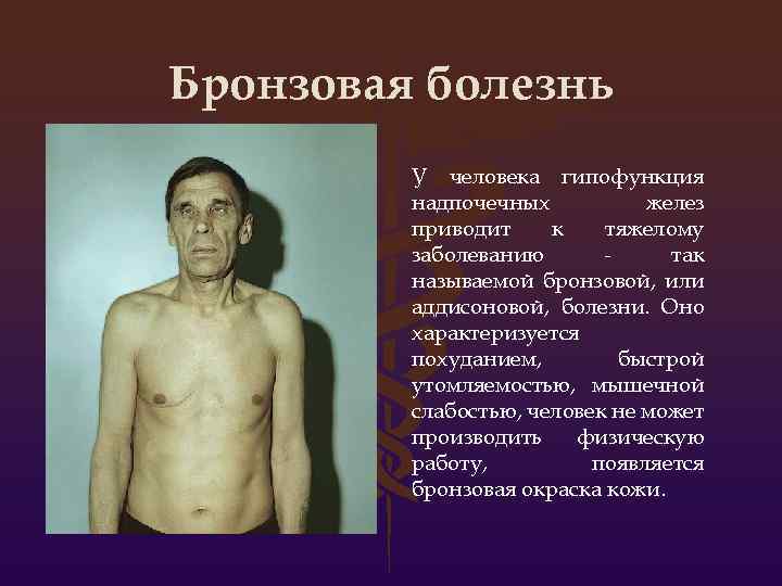 Бронзовая болезнь У человека гипофункция надпочечных желез приводит к тяжелому заболеванию так называемой бронзовой,
