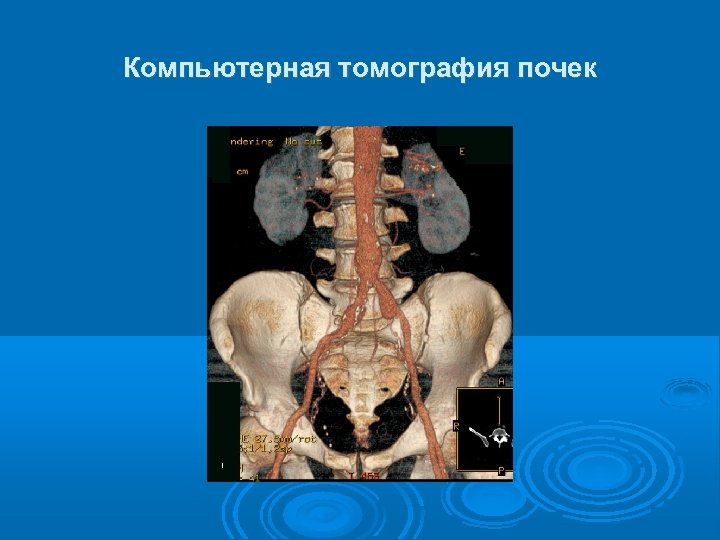 Компьютерная томография почек 