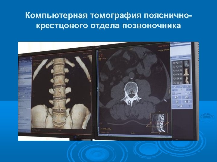 Компьютерная томография поясничнокрестцового отдела позвоночника 