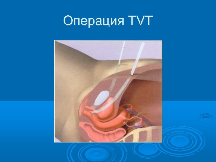 Операция TVT 