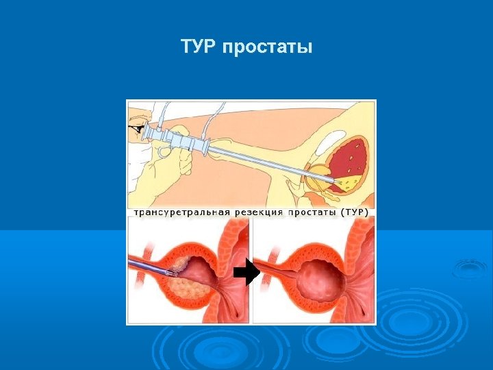 ТУР простаты 