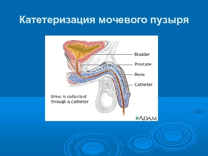 Катетеризация мочевого пузыря 