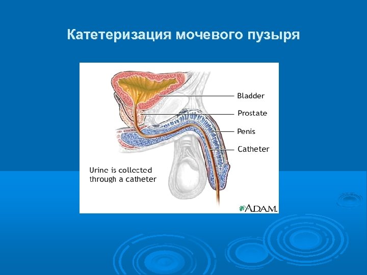 Катетеризация мочевого пузыря 