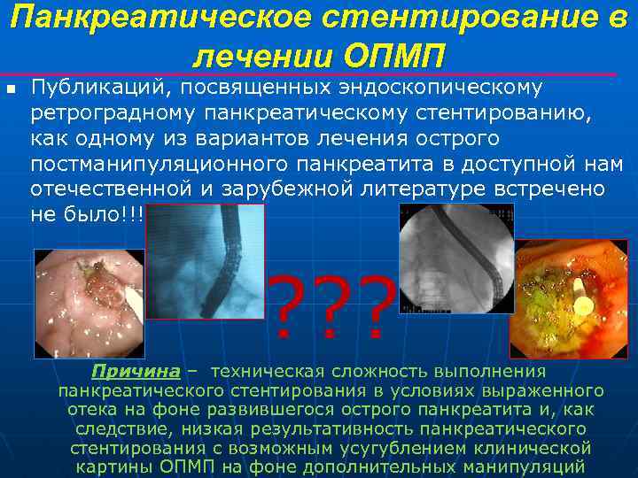 Панкреатическое стентирование в лечении ОПМП n Публикаций, посвященных эндоскопическому ретроградному панкреатическому стентированию, как одному