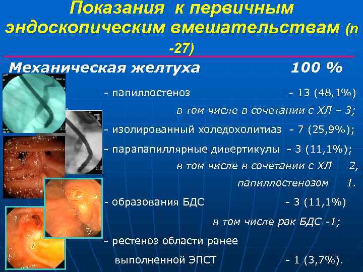 Показания к первичным эндоскопическим вмешательствам (n -27) Механическая желтуха 100 % - папиллостеноз (48,