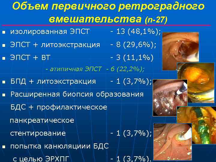 Объем первичного ретроградного вмешательства (n-27) n изолированная ЭПСТ - 13 (48, 1%); n ЭПСТ