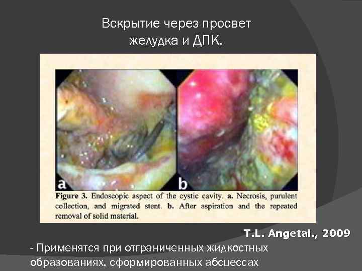 Вскрытие через просвет желудка и ДПК. T. L. Angetal. , 2009 - Применятся при