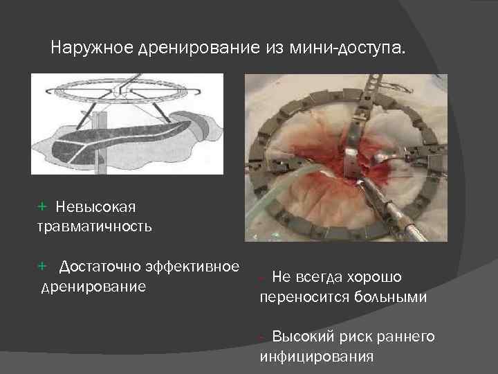 Наружное дренирование из мини-доступа. + Невысокая травматичность + Достаточно эффективное дренирование - Не всегда