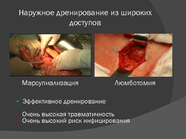 Наружное дренирование из широких доступов Марсупиализация Люмботомия + Эффективное дренирование - Очень высокая травматичность