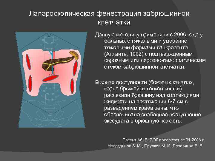 Лапароскопическая фенестрация забрюшинной клетчатки Данную методику применяли с 2006 года у больных с тяжелыми