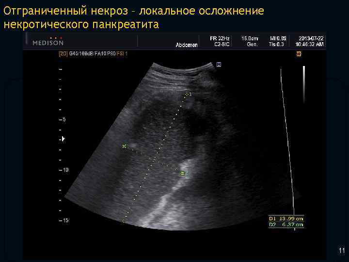 Отграниченный некроз – локальное осложнение некротического панкреатита 11 