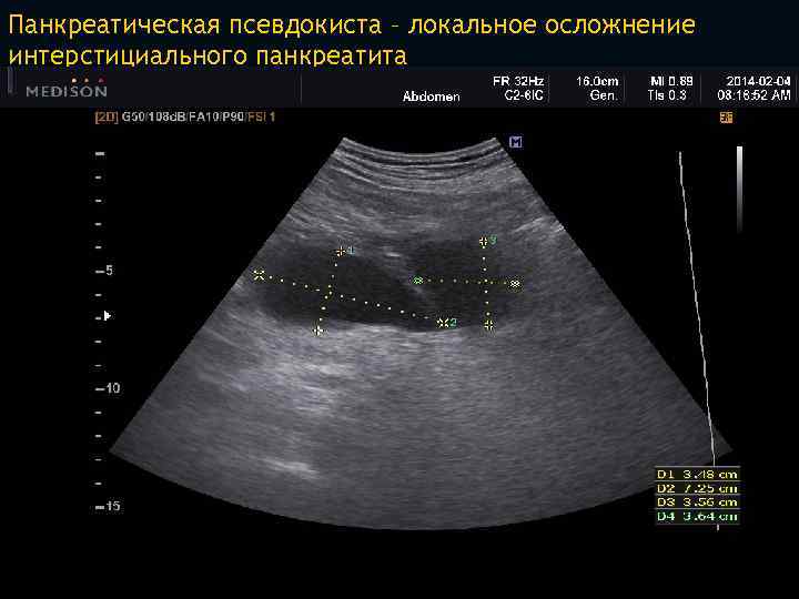 Аденома поджелудочной железы на узи фото