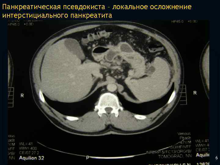Панкреатическая псевдокиста – локальное осложнение интерстициального панкреатита 6 
