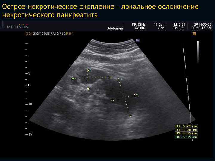 Острое некротическое скопление – локальное осложнение некротического панкреатита 8 