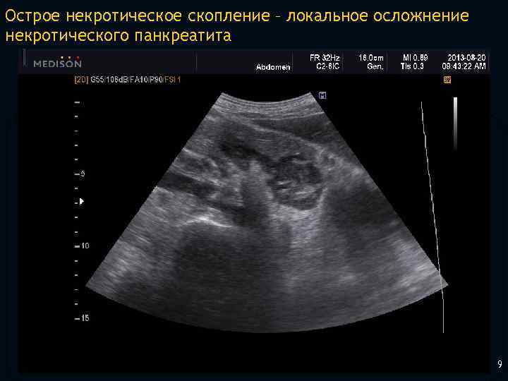 Острое некротическое скопление – локальное осложнение некротического панкреатита 9 