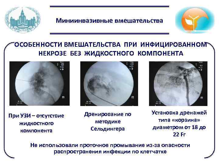 Миниинвазивные вмешательства ОСОБЕННОСТИ ВМЕШАТЕЛЬСТВА ПРИ ИНФИЦИРОВАННОМ НЕКРОЗЕ БЕЗ ЖИДКОСТНОГО КОМПОНЕНТА При УЗИ – отсутствие