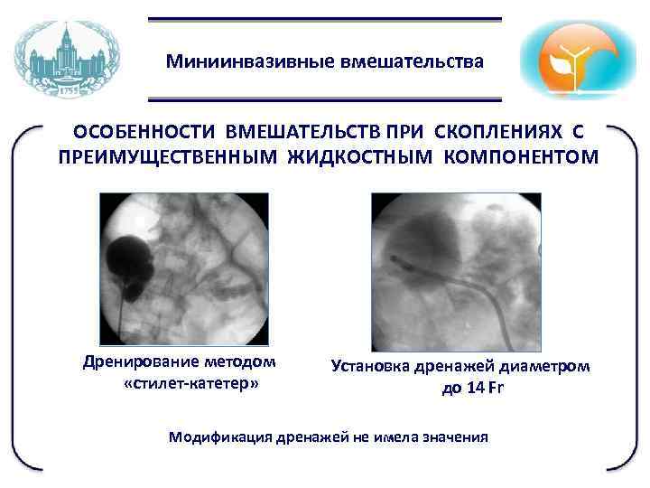 Миниинвазивные вмешательства ОСОБЕННОСТИ ВМЕШАТЕЛЬСТВ ПРИ СКОПЛЕНИЯХ С ПРЕИМУЩЕСТВЕННЫМ ЖИДКОСТНЫМ КОМПОНЕНТОМ Дренирование методом «стилет-катетер» Установка