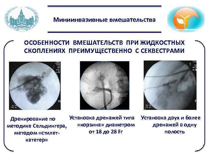 Миниинвазивные вмешательства ОСОБЕННОСТИ ВМЕШАТЕЛЬСТВ ПРИ ЖИДКОСТНЫХ СКОПЛЕНИЯХ ПРЕИМУЩЕСТВЕННО С СЕКВЕСТРАМИ Установка дренажей типа Дренирование
