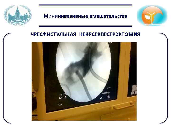 Миниинвазивные вмешательства ЧРЕСФИСТУЛЬНАЯ НЕКРСЕКВЕСТРЭКТОМИЯ 