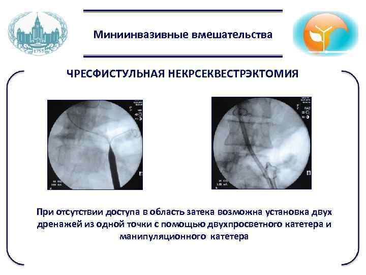 Миниинвазивные вмешательства ЧРЕСФИСТУЛЬНАЯ НЕКРСЕКВЕСТРЭКТОМИЯ При отсутствии доступа в область затека возможна установка двух дренажей