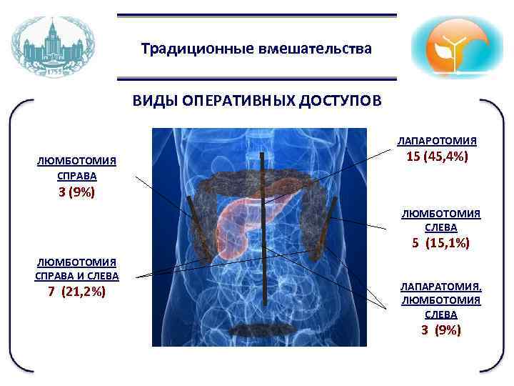 Традиционные вмешательства ВИДЫ ОПЕРАТИВНЫХ ДОСТУПОВ ЛАПАРОТОМИЯ ЛЮМБОТОМИЯ СПРАВА 15 (45, 4%) 3 (9%) ЛЮМБОТОМИЯ