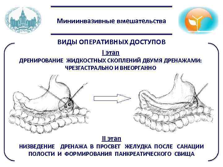 Миниинвазивные вмешательства ВИДЫ ОПЕРАТИВНЫХ ДОСТУПОВ I этап ДРЕНИРОВАНИЕ ЖИДКОСТНЫХ СКОПЛЕНИЙ ДВУМЯ ДРЕНАЖАМИ: ЧРЕЗГАСТРАЛЬНО И