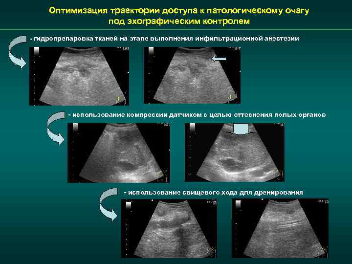 Оптимизация траектории доступа к патологическому очагу под эхографическим контролем - гидропрепаровка тканей на этапе